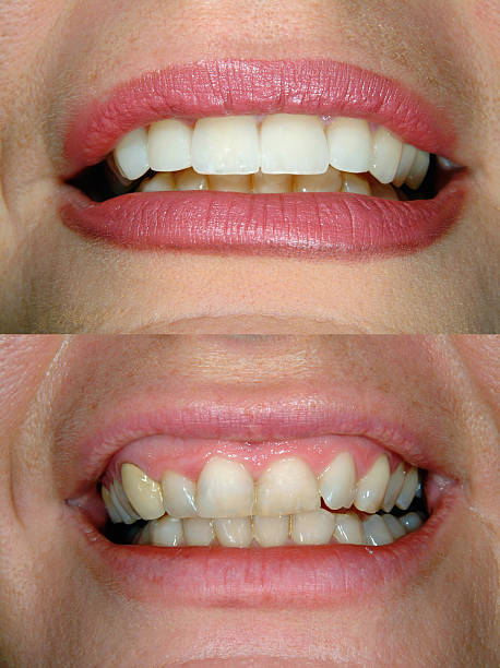 Before and after Smile design dental procedure photos . Selective soft focus.