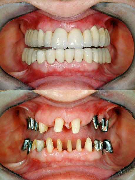 Before and after full dental reconstruction  procedure photos . Selective soft focus.You can find more dental related images like this one here :