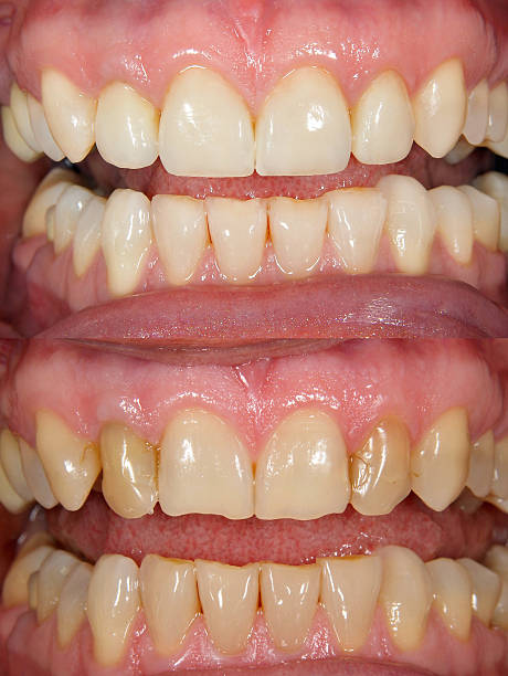 Before and after Smile design dental procedure photos . Selective soft focus.You can find more dental related images like this one here :